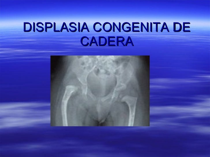 displasia congenita de cadera ortopedia